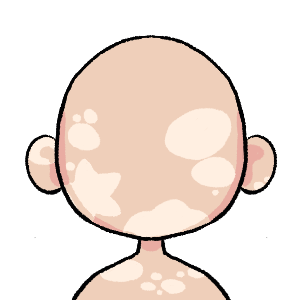 Vitiligo 1